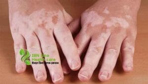 শ্বেতী রোগ কি কি কারণে হয়? কখন শ্বেতী রোগ বেড়ে যায়, প্রতিকার কি?