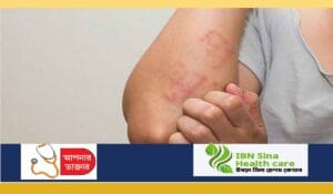 এলার্জিজনিত নানাবিধ সমস্যা ও প্রতিরোধের উপায়