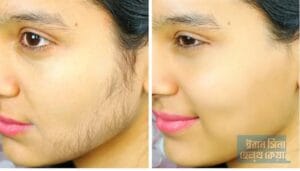 পুরো শরীরে লোম বেড়ে যাওয়ার কারণ কি?