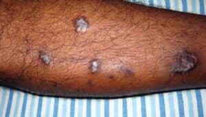 Lichen planus কি ধরনের রোগ? প্রতিকার কি?