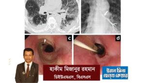 ব্রঙ্কিয়াল ফিস্টুলার কারণ ও প্রতিকার কি? জেনে নিন