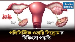 পলিসিস্টিক ওভারি সিন্ড্রোম বা PCOS কি? কারণ ও প্রতিকার