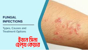 ফাঙ্গাল ইনফেকশন কেন হয়? জেনে নিন কারণ ও প্রতিকার